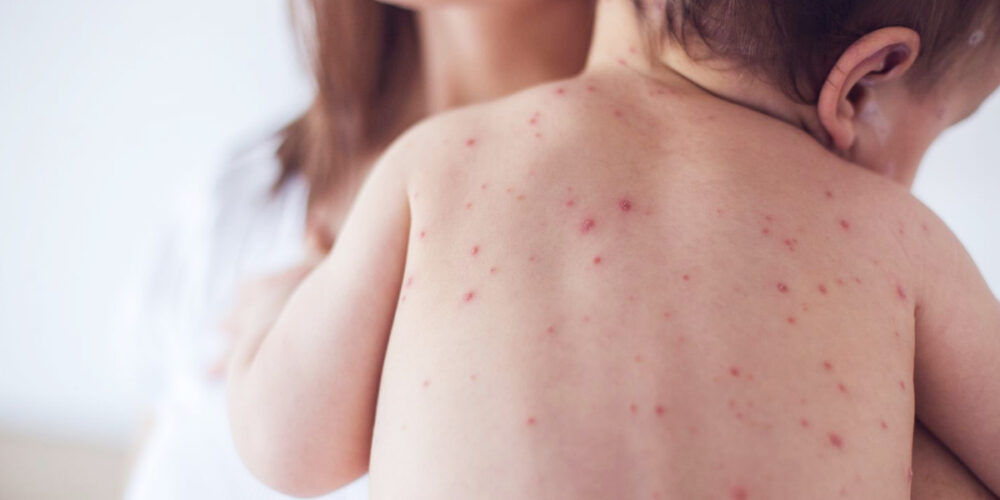 Measles becoming an epidemic in Kathmandu