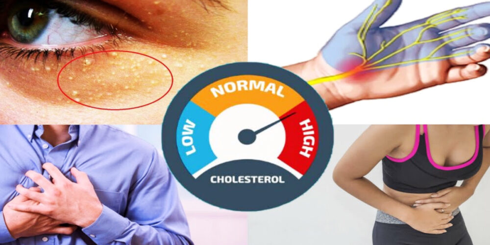 high cholesterol symptoms